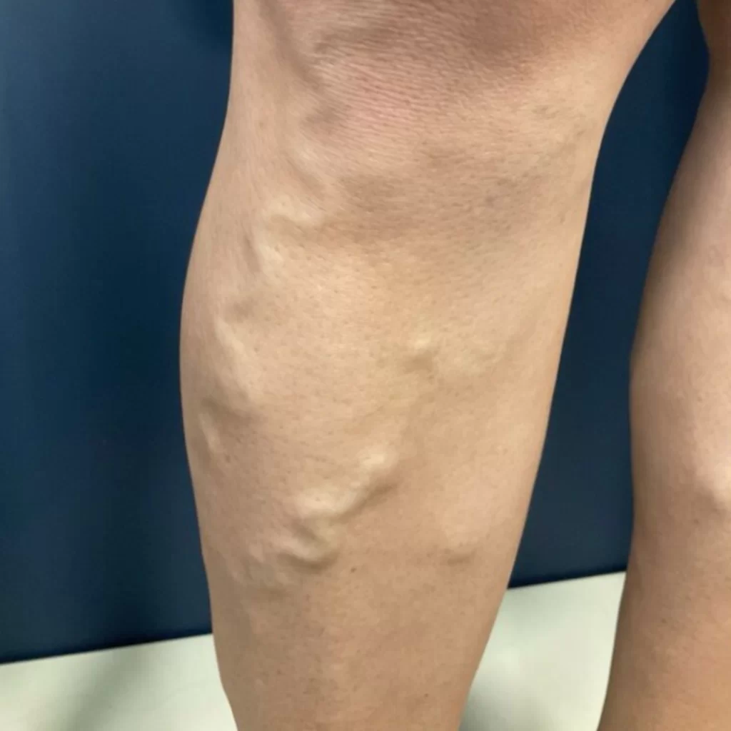 Varizes nas pernas: causas, sintomas e quando procurar um cirurgião vascular em Divinópolis